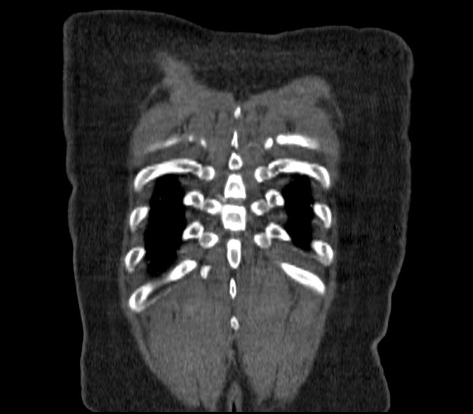 File:Adenocarcinoma of the lung (Radiopaedia 44205-47803 Coronal C+ portal venous phase 93).jpg
