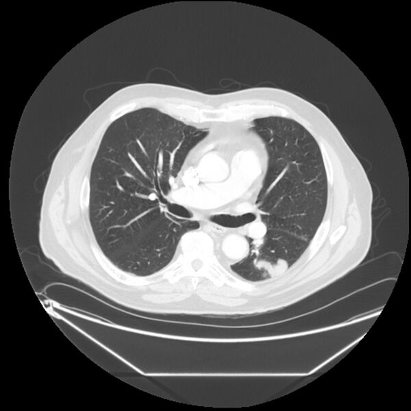 File:Adenocarcinoma of the lung (Radiopaedia 44876-48759 Axial lung window 37).jpg