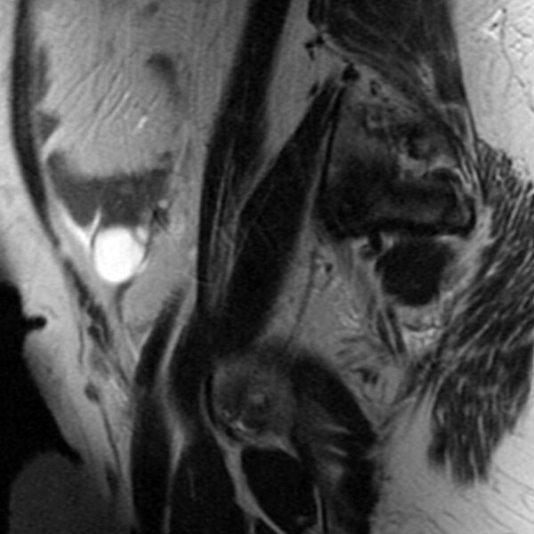 File:Adenomyosis of the uterus (Radiopaedia 9869-10437 Sagittal T2 8).jpg