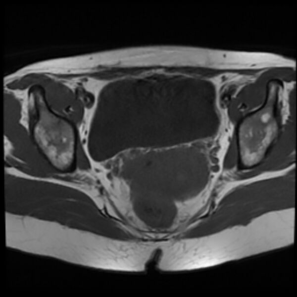 File:Adenomyosis within a septate uterus (Radiopaedia 69963-79981 Axial T1 18).jpg