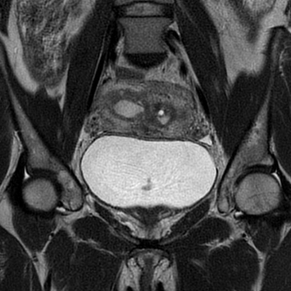 File:Adenomyosis within a septate uterus (Radiopaedia 69963-79981 Coronal T2 12).jpg