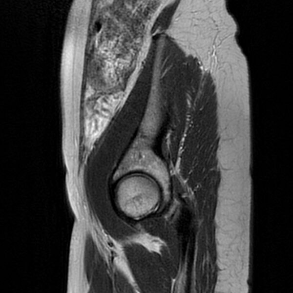 File:Adenomyosis within a septate uterus (Radiopaedia 69963-79981 Sagittal T2 1).jpg