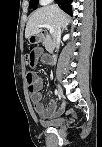 File:Adhesional small bowel obstruction (Radiopaedia 58900-66131 Sagittal C+ portal venous phase 104).jpg