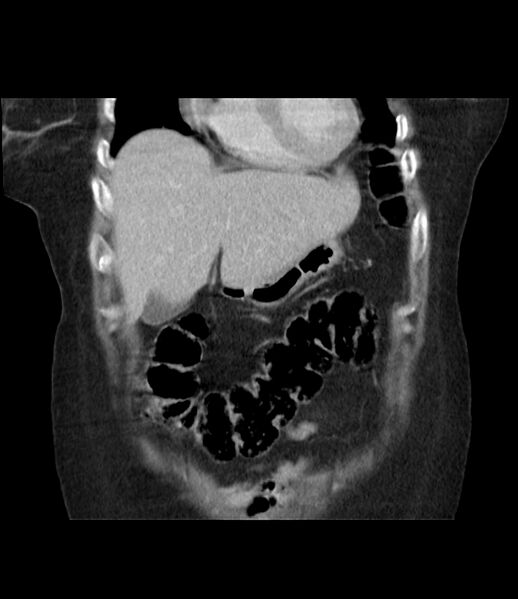 File:Adrenal cortical carcinoma with IVC invasion and thrombosis (Radiopaedia 34307-35597 Coronal C+ portal venous phase 15).jpg