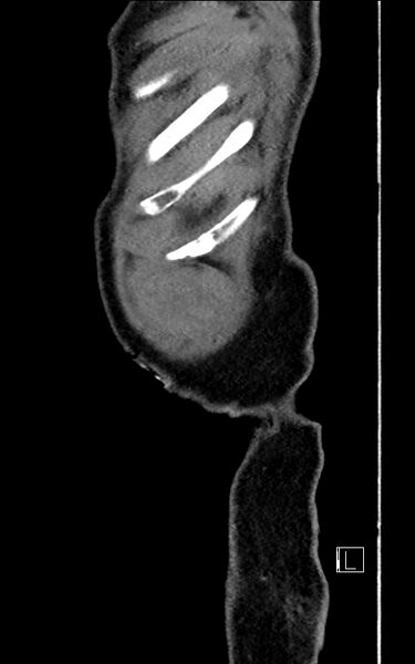 File:Adrenal lymphoma (Radiopaedia 73730-84529 Sagittal C+ portal venous phase 3).jpg