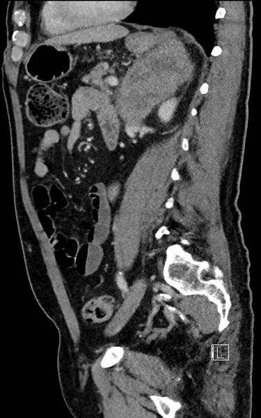 File:Adrenal lymphoma (Radiopaedia 73730-84529 Sagittal C+ portal venous phase 71).jpg