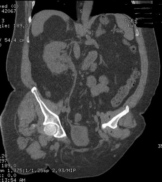 File:Adrenal myelolipoma (Radiopaedia 26278-26407 Coronal non-contrast 1).jpg