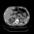 Adrenal myelolipoma (Radiopaedia 41843-44834 Axial non-contrast 20).jpg