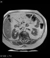 Adrenal myelolipoma (Radiopaedia 6765-7961 Axial T1 in-phase 26).jpg
