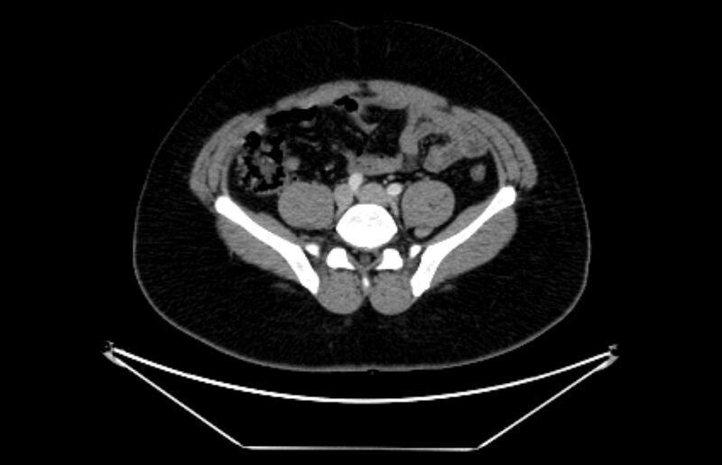 File:Adrenocortical carcinoma (Radiopaedia 80134-93438 Axial C+ portal venous phase 91).jpg
