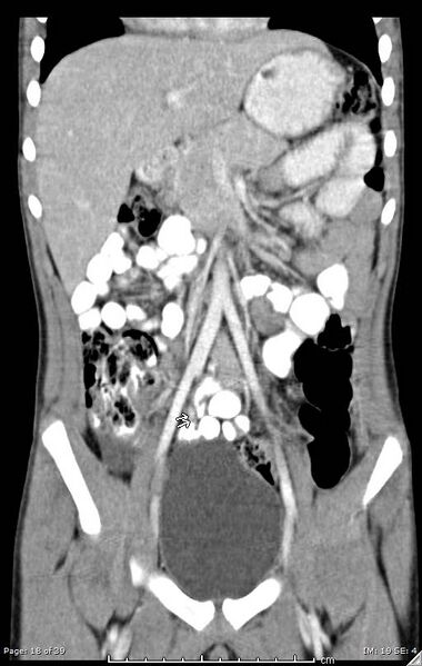 File:Agenesis of the gallbladder (Radiopaedia 55454-61905 A 18).jpg