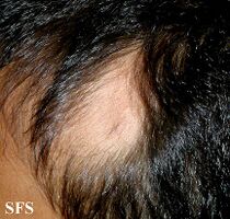 Alopecia Triangularis Congenita
