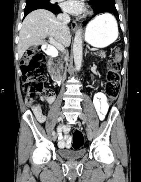 File:Ampullary adenocarcinoma (Radiopaedia 86093-102032 C 36).jpg