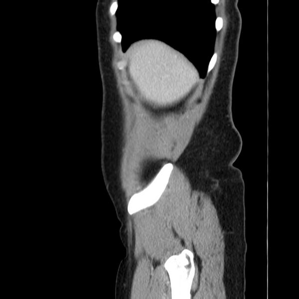 File:Ampullary tumor (Radiopaedia 22787-22816 D 7).jpg