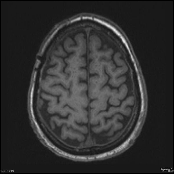 File:Anaplastic meningioma with recurrence (Radiopaedia 34452-35788 Axial T1 114).jpg