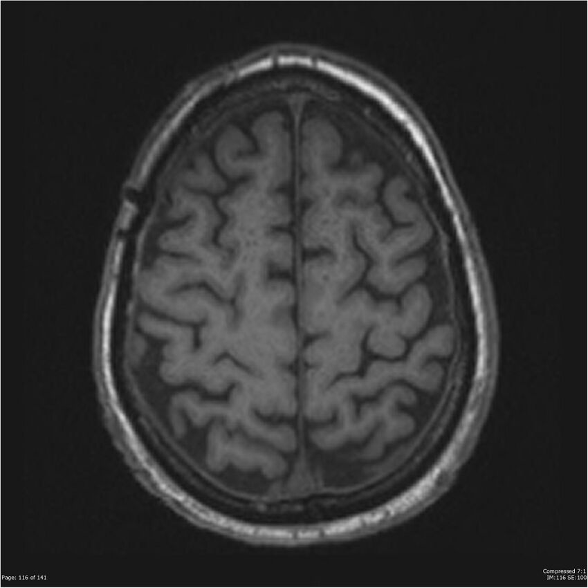 Anaplastic meningioma with recurrence (Radiopaedia 34452-35788 Axial T1 114).jpg