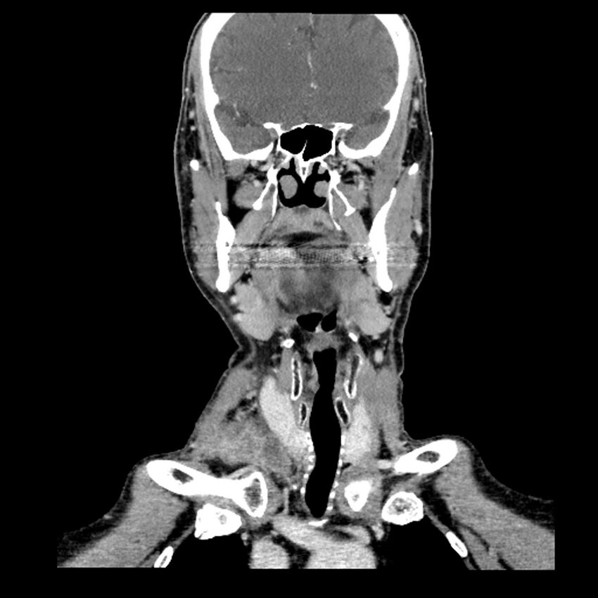 Anaplastic thyroid carcinoma (Radiopaedia 79087-92034 A 52).jpg