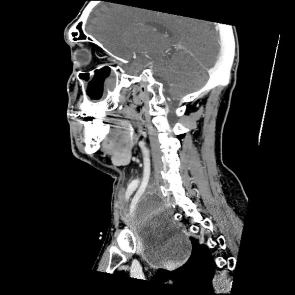 File:Anaplastic thyroid carcinoma (Radiopaedia 79087-92034 C 38).jpg