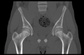 Aneurysmal bone cyst of ischium (Radiopaedia 25957-26094 Coronal bone window 19).png