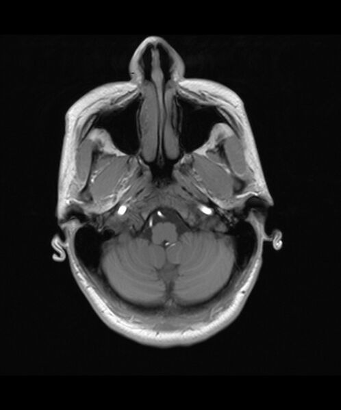 File:Angiomatous meningioma (Radiopaedia 79459-92579 Axial T1 3).jpg