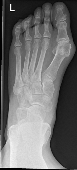 File:Anterior calcaneal process fracture (Radiopaedia 47384-51988 Frontal 1).png