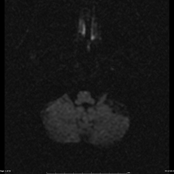File:Anterior choroidal artery infarct (Radiopaedia 24302).jpg