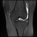 Anterior cruciate ligament tear, Wrisberg rip and bucket-handle tear of medial meniscus (Radiopaedia 75872-87266 Coronal PD fat sat 13).jpg