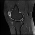 Anterior cruciate ligament tear, Wrisberg rip and bucket-handle tear of medial meniscus (Radiopaedia 75872-87266 Sagittal PD fat sat 18).jpg