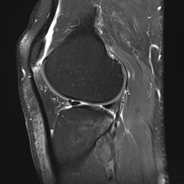 File:Anterior cruciate ligament tear - ramp lesion (Radiopaedia 71883-82322 Sagittal PD fat sat 8).jpg