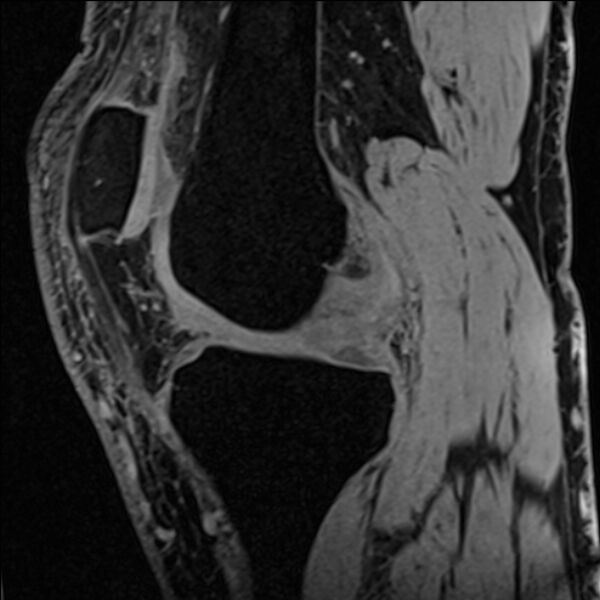 File:Anterior cruciate ligament tear - ramp lesion (Radiopaedia 71883-82322 Sagittal T1 vibe 86).jpg