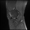 Anterior cruciate ligament tear with posteromedial corner injury, bucket-handle meniscal tear and chondral delamination (Radiopaedia 75501-86744 Sagittal PD fat sat 4).jpg