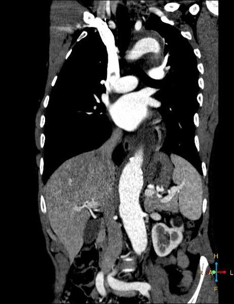 File:Aortic aneurysm and penetrating ulcer (Radiopaedia 23590-23704 B 7).jpg