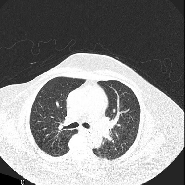 File:Aortic arch false aneurysm (Radiopaedia 14667-14587 Axial lung window 11).jpg
