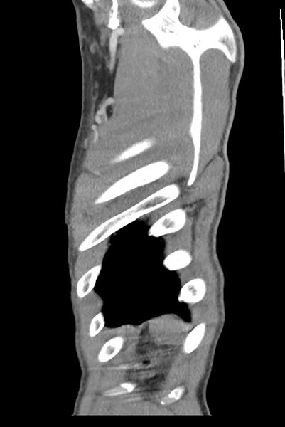 File:Aortic coarctation with aneurysm (Radiopaedia 74818-85828 B 146).jpg