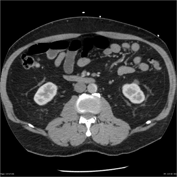File:Aortic dissection- Stanford A (Radiopaedia 37759-39664 A 105).jpg