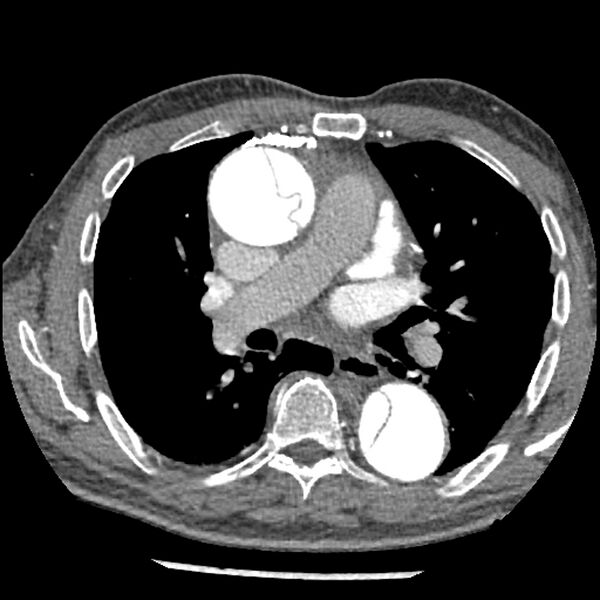 File:Aortic dissection - DeBakey Type I-Stanford A (Radiopaedia 79863-93115 A 17).jpg