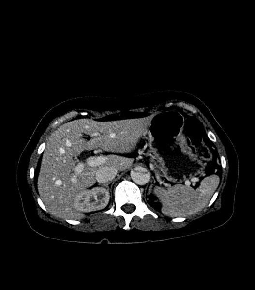 File:Aortic dissection with renal ischemia (Radiopaedia 76573-88338 B 26).jpg