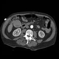 Aortic dissection with rupture into pericardium (Radiopaedia 12384-12647 A 65).jpg