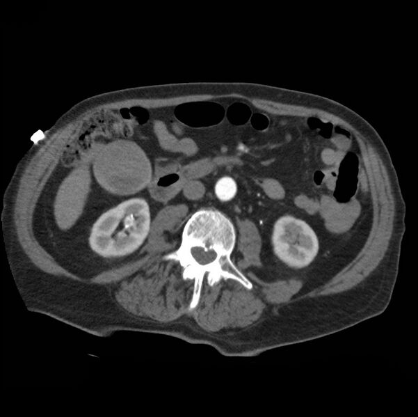 File:Aortic dissection with rupture into pericardium (Radiopaedia 12384-12647 A 65).jpg