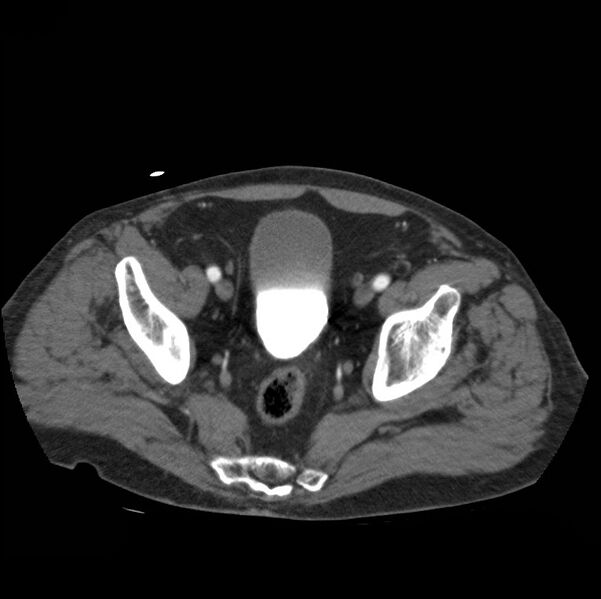 File:Aortic dissection with rupture into pericardium (Radiopaedia 12384-12647 A 82).jpg