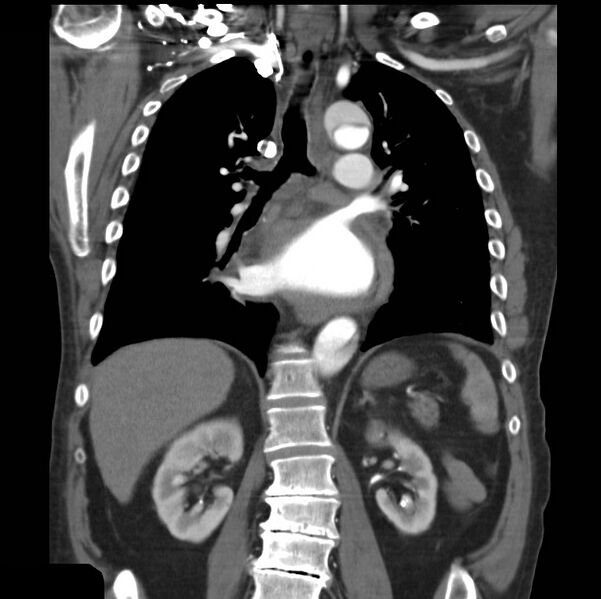 File:Aortic dissection with rupture into pericardium (Radiopaedia 12384-12647 B 26).jpg