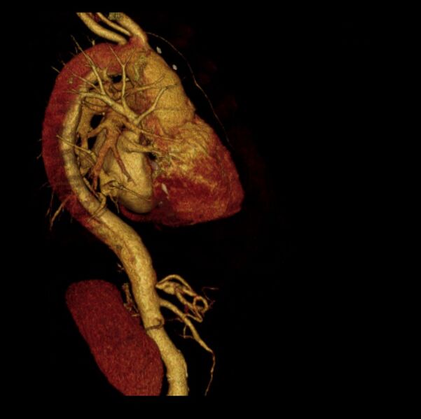 File:Aortic dissection with rupture into pericardium (Radiopaedia 12384-12647 D 11).jpg