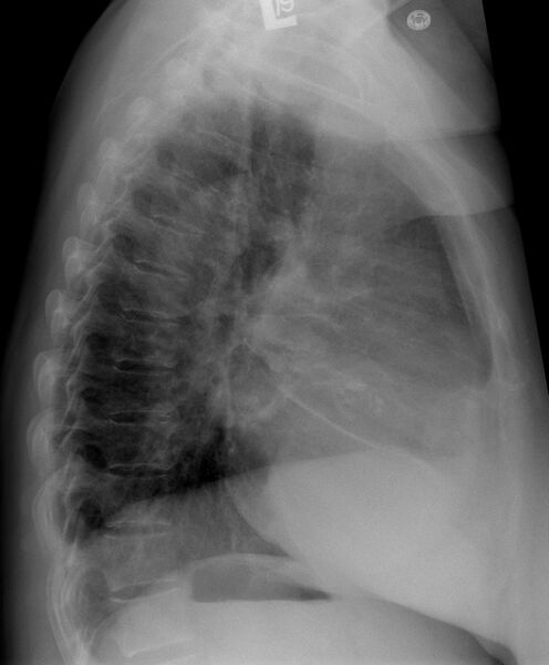 File:Aortic valve stenosis (Radiopaedia 14480-14422 A 1).jpg