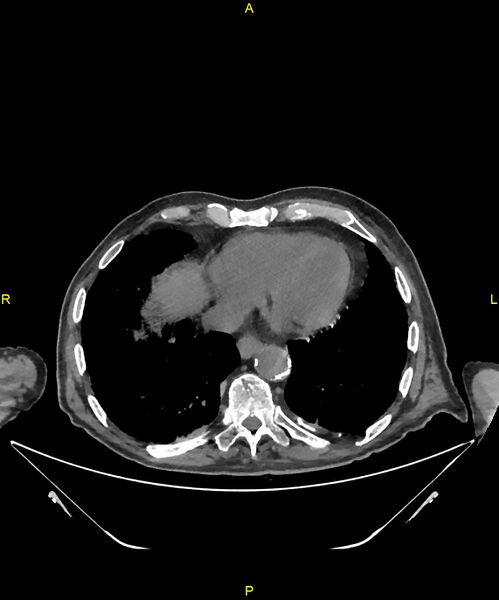 File:Aortoenteric fistula (Radiopaedia 84308-99603 Axial non-contrast 3).jpg
