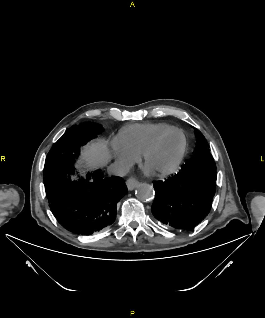Aortoenteric fistula (Radiopaedia 84308-99603 Axial non-contrast 3).jpg
