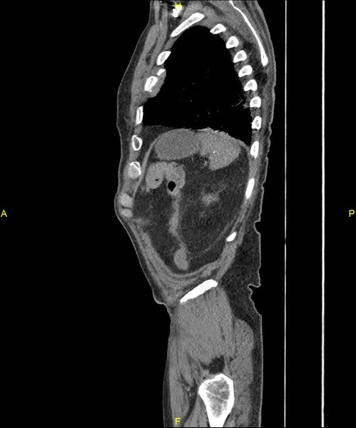 File:Aortoenteric fistula (Radiopaedia 84308-99603 C 294).jpg