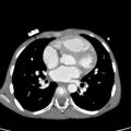 Aortopulmonary window, interrupted aortic arch and large PDA giving the descending aorta (Radiopaedia 35573-37074 B 50).jpg