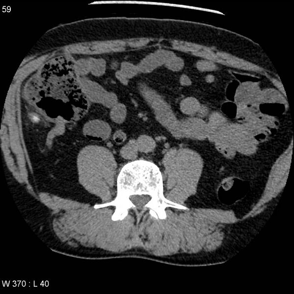File:Appendicitis (Radiopaedia 12510-12733 Axial non-contrast 26).jpg