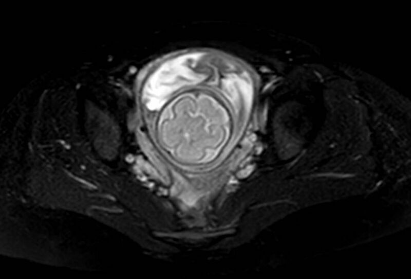 File:Appendicitis in gravida (MRI) (Radiopaedia 89433-106395 Axial T2 SPAIR 66).jpg
