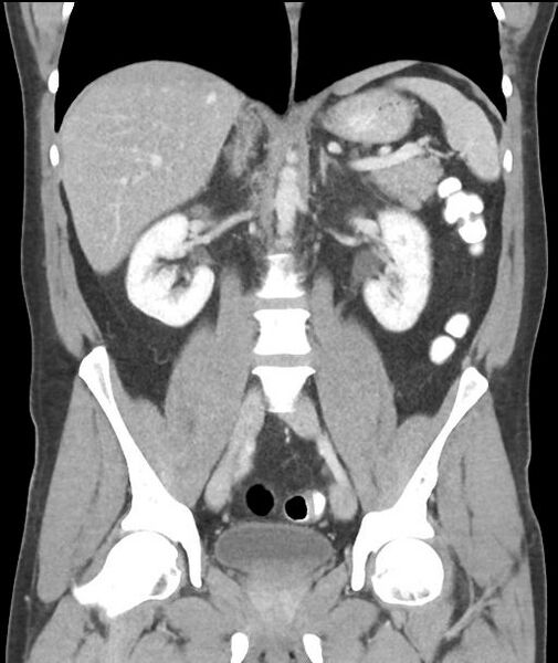 File:Appendicitis with cecal bar sign (Radiopaedia 31878-32830 A 36).jpg